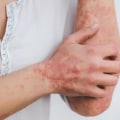 Reducing Risk of Psoriasis and Eczema with Vitamin D