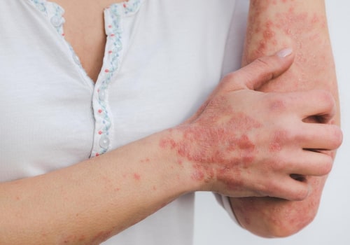 Reducing Risk of Psoriasis and Eczema with Vitamin D